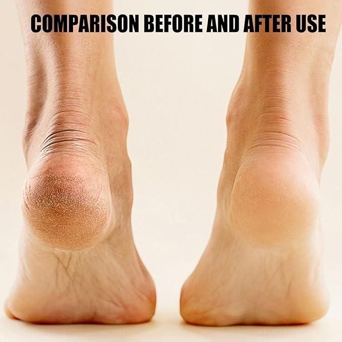 Electronic Pedicure Foot Grinder – Rechargeable Callus Remover & Dead Skin Exfoliator